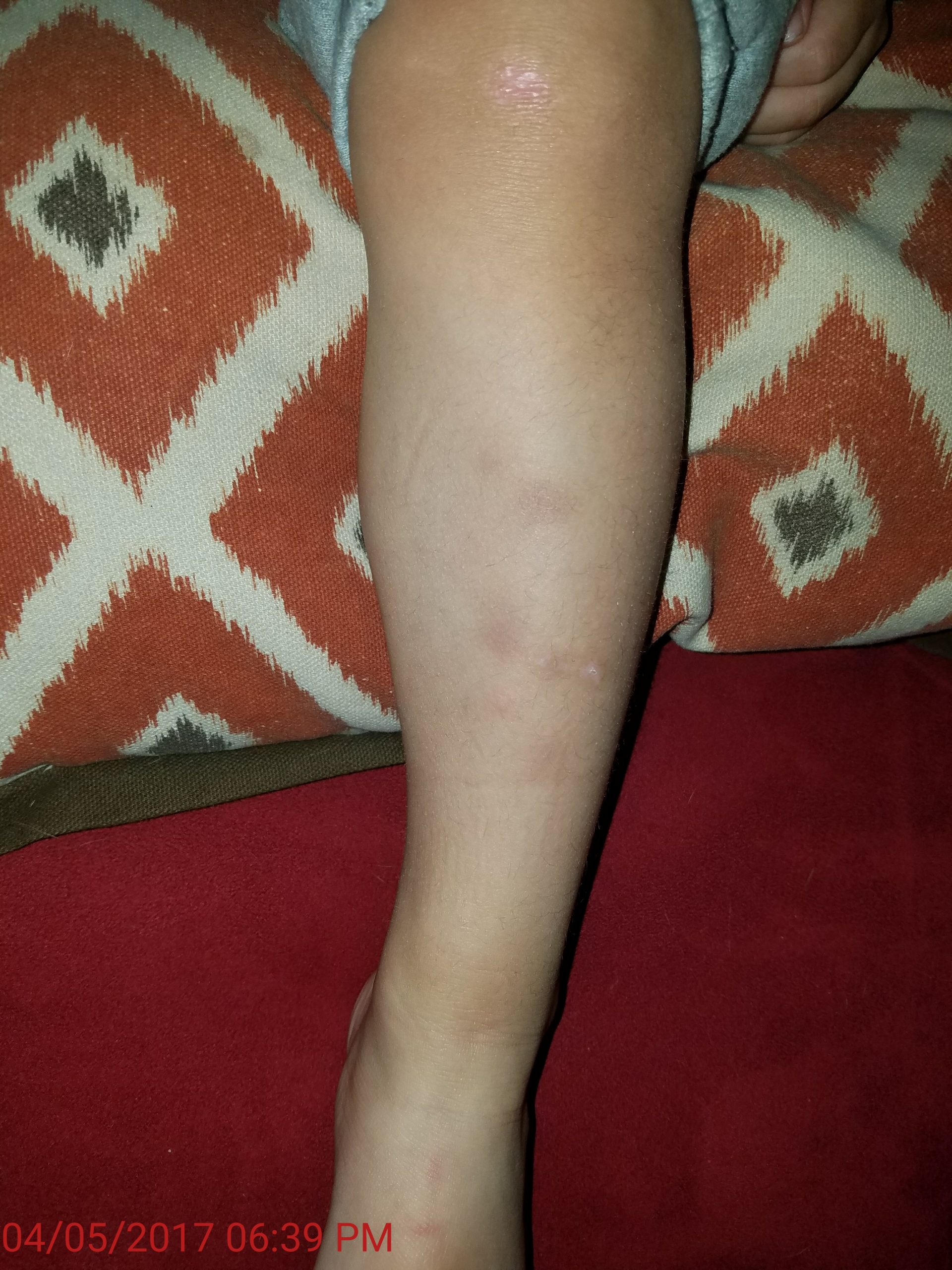 random bruises on legs anemia